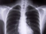 Nowe perspektywy dla chorych na raka płuca